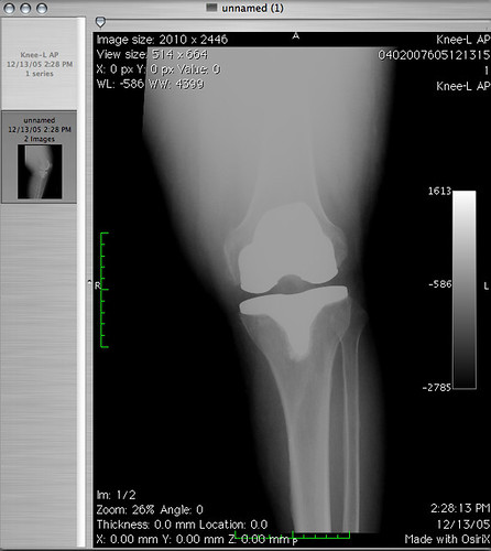 my left knee back to front view after total knee replacement