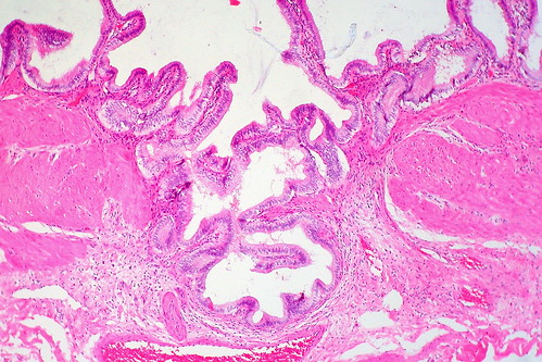 Rokitansky-Aschoff Sinus, Gallbladder